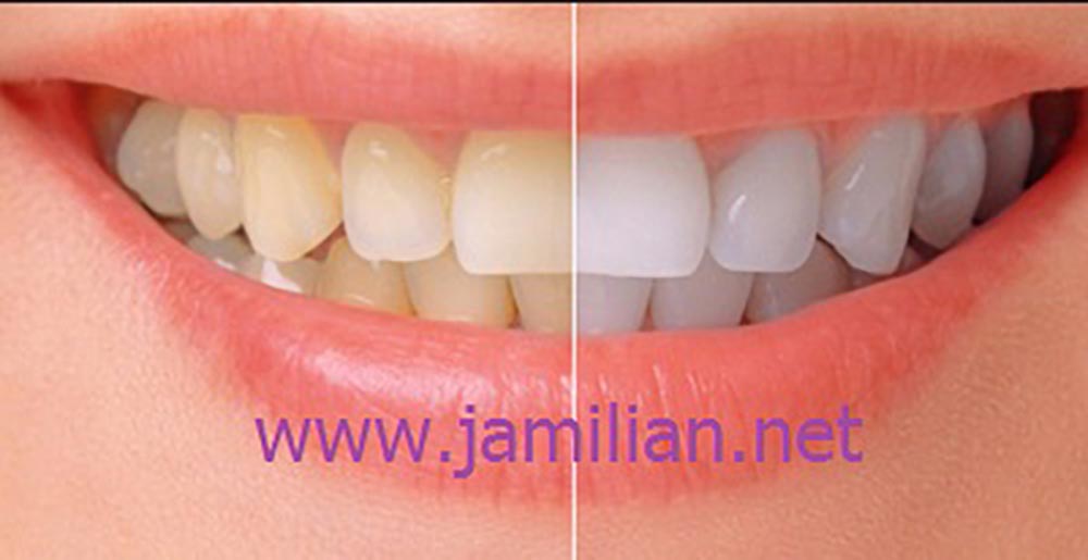 Vor und nach Zahnverfärbungen
