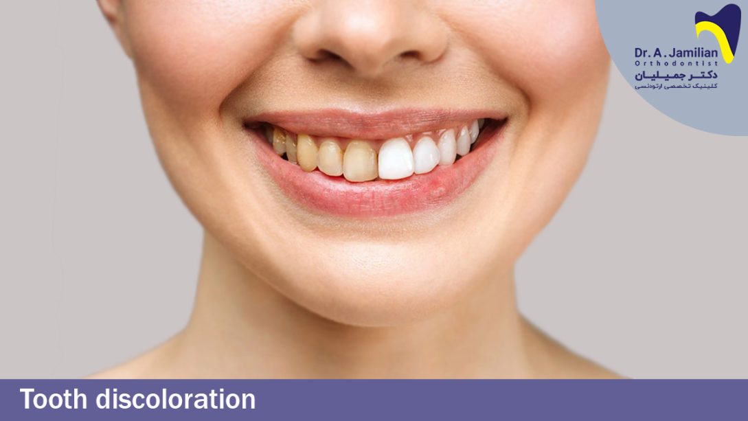 Tooth discoloration Dr Jamilian