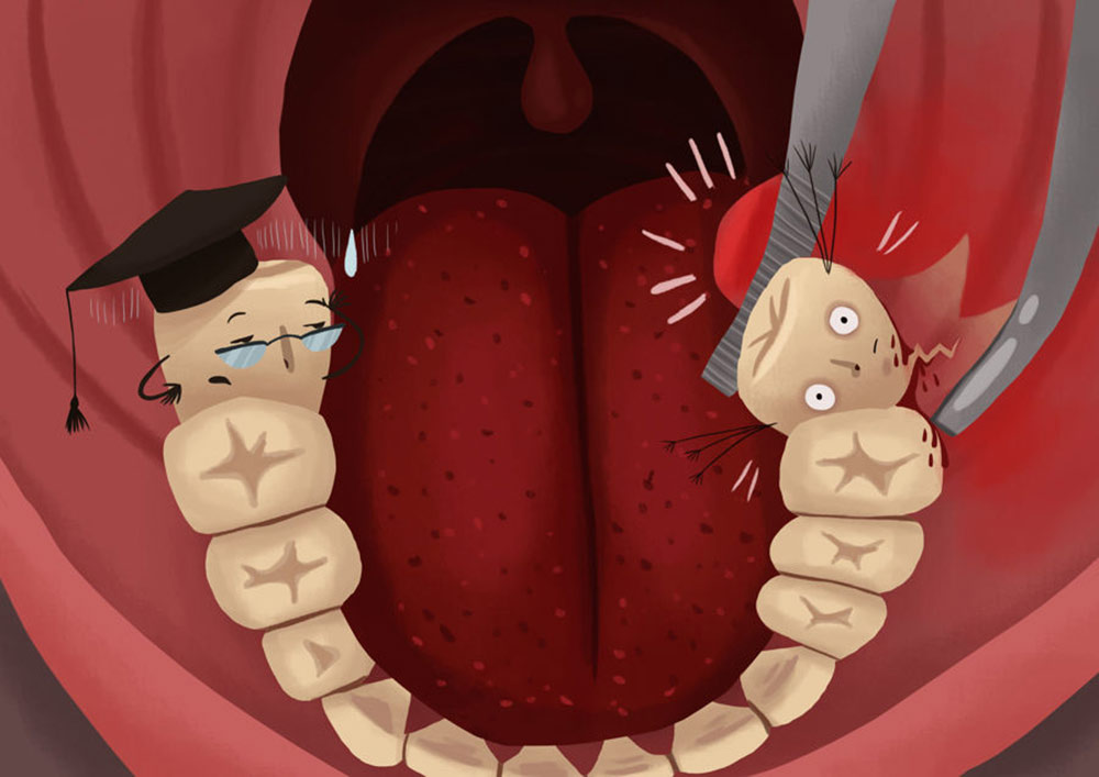 extraction of wisdom tooth