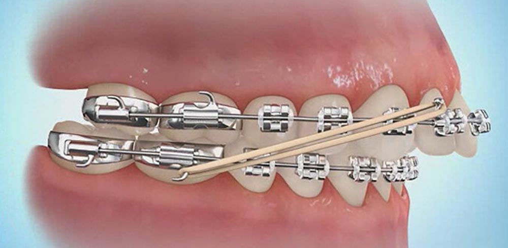 Application of orthodontic elastic band