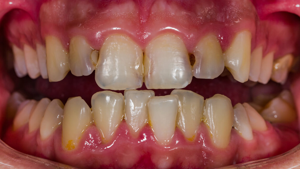 front tooth decay