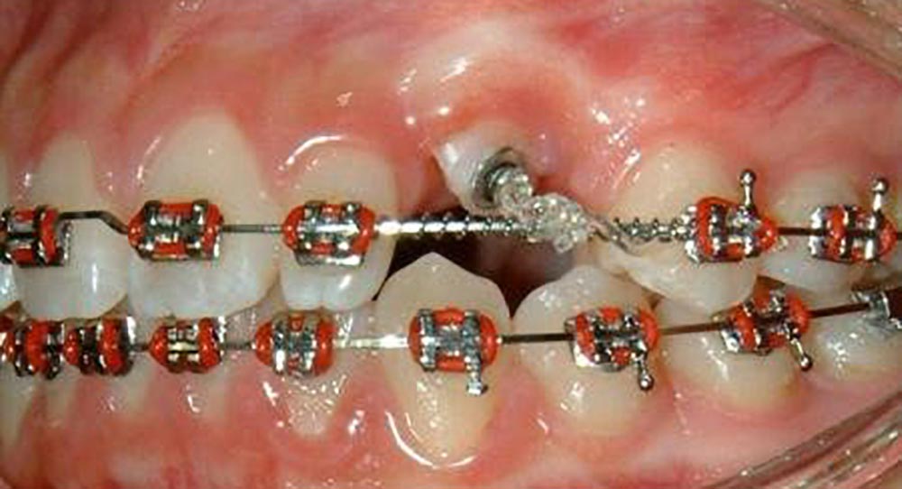 علاج الأنياب الکامنة بتقويم الأسنان