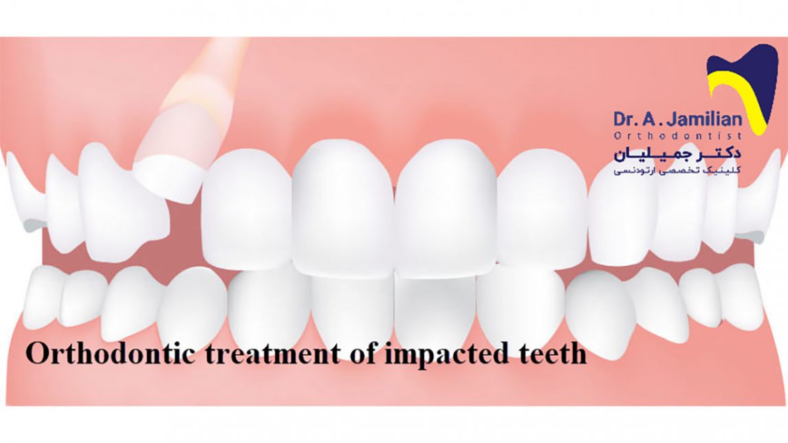 Orthodontic treatment of impacted teeth - Dr Jamilian