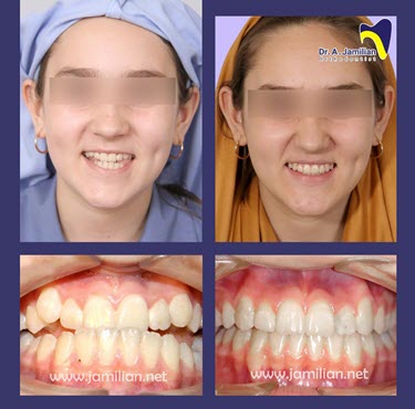 orthodontic before and after face shape