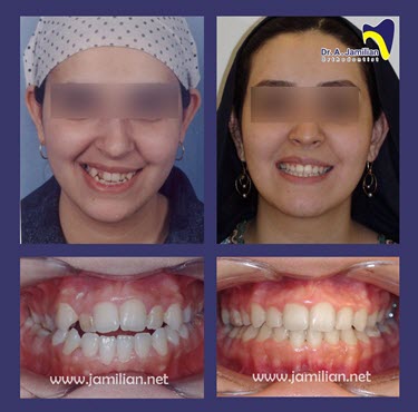 orthodontic before and after jawline