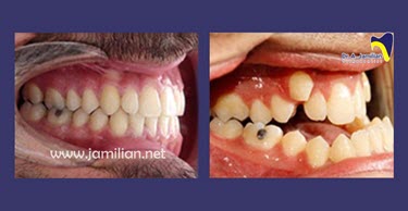 orthodontic treatment pre and post pictures