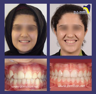 الصور قبل وبعد تقويم الأسنان