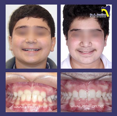 do orthodontists reshape teeth after braces
