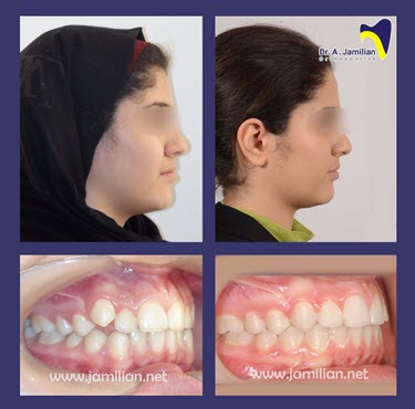 vor und nach der kieferorthopädischen zahnbehandlung