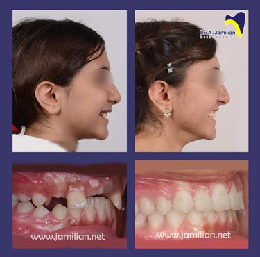 braces before and after gap impacted incisors side view
