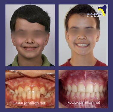 braces before and after front view