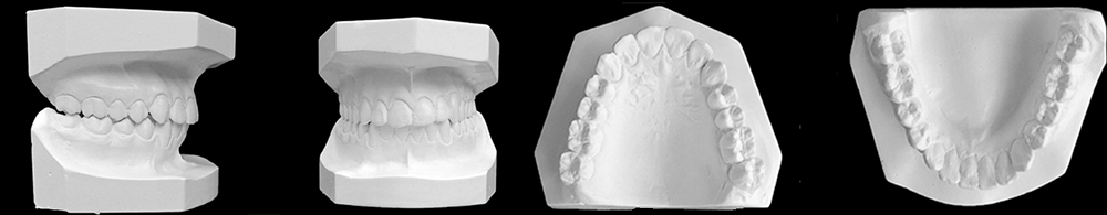 Orthodontic mold from four sides