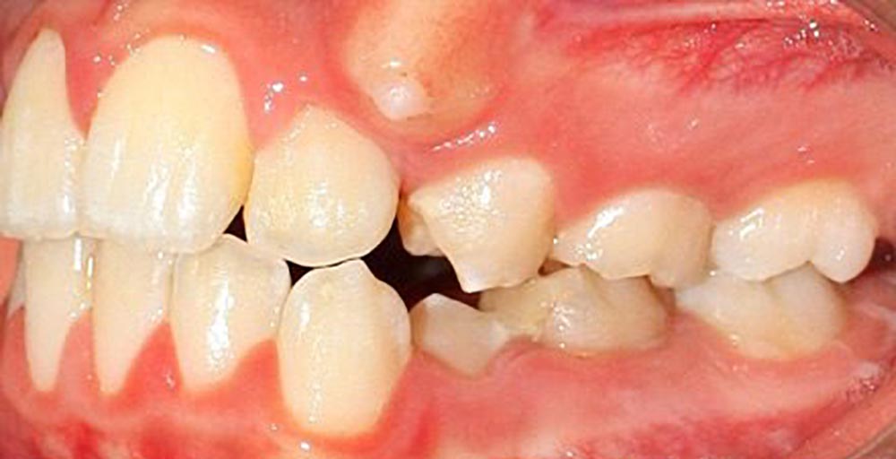 وضع الأنياب الکامنة في فم المريض