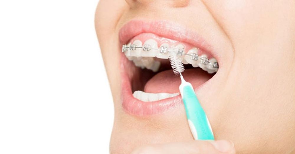 Ein kieferorthopädischer Patient, der Karies durch Zähneputzen verhindert
