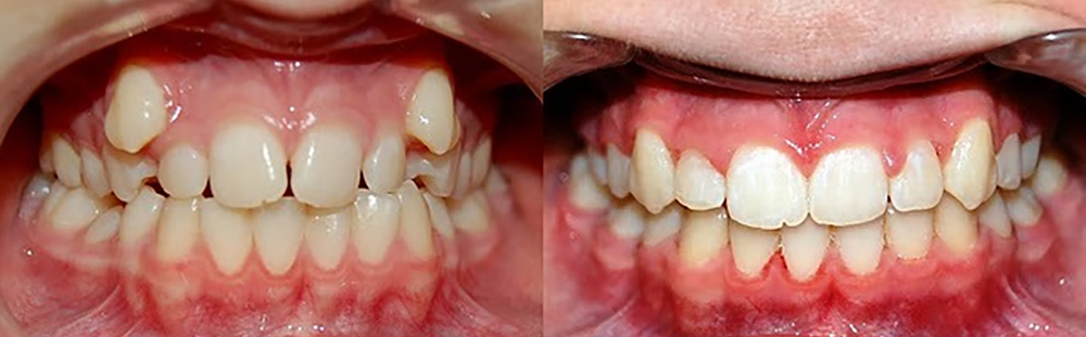 Vor und nach der Behandlung einer Oberkieferstenose mit Zahnluxation