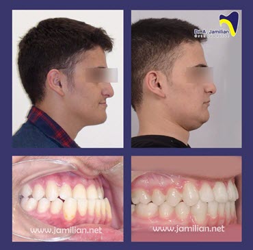 braces before and after face shape side view