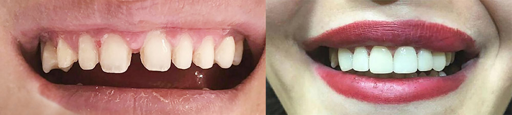 Vor und nach der Behandlung der Zahnlücke mit Komposit