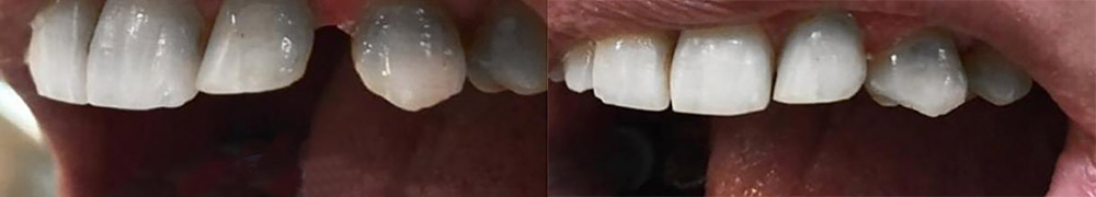 before and after treatment of the gap between the teeth with dental veneers