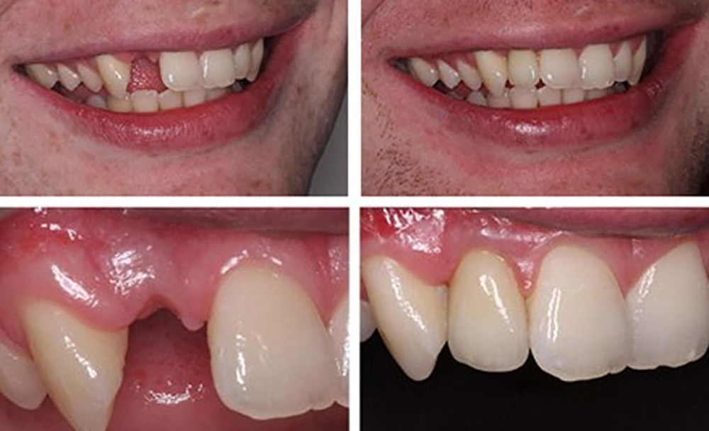before and after treatment of the gap between the teeth with a dental implant
