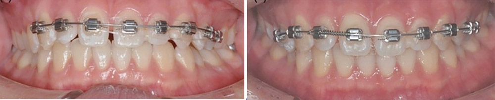 تصویر درمان فاصله بین دندان ها حین درمان ارتودنسی