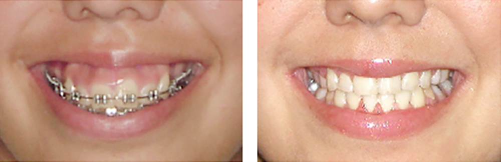 Vor und nach der kieferorthopädischen Wirkung auf das Zahnfleischlächeln