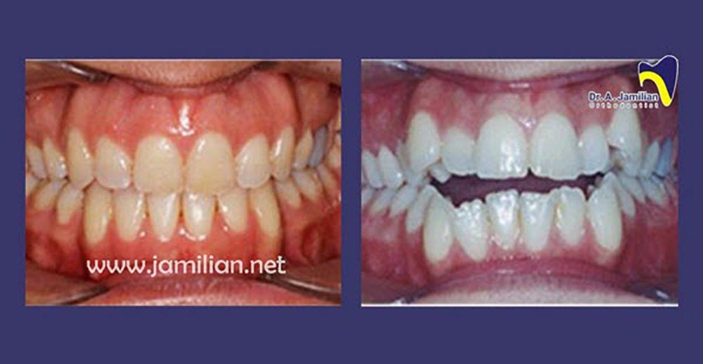 قبل و بعد تاثیر ارتودنسی بر زیبایی دندان ها