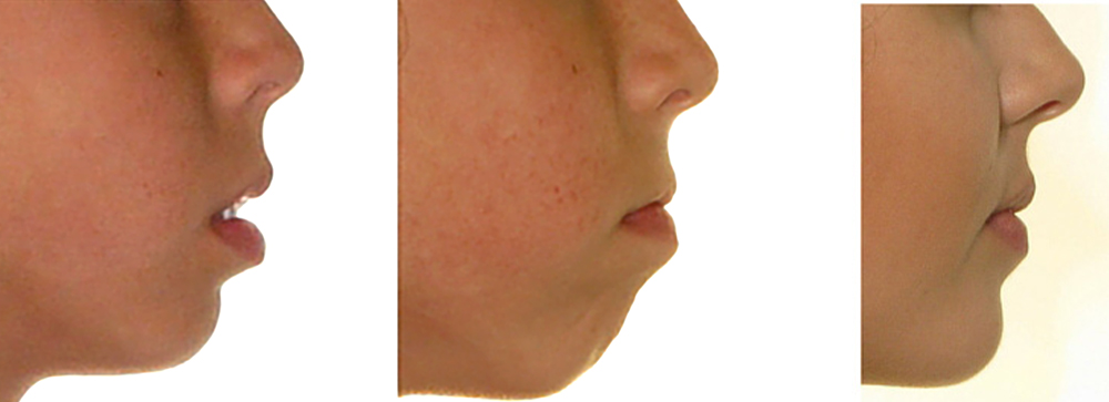 Vor und nach der Wirkung der Kieferorthopädie auf die Lippen
