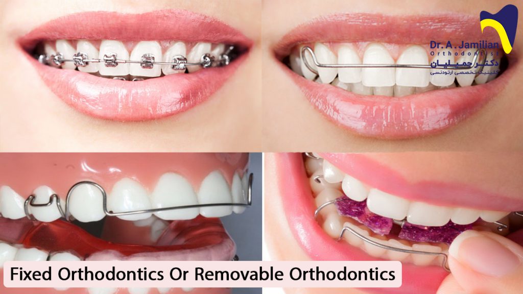 Fixed orthodontic or removable orthodontics Dr Jamilian
