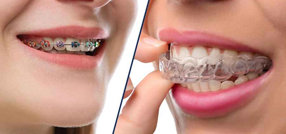 the image on the left is fixed orthodontic and the image on the right is removable orthodontics