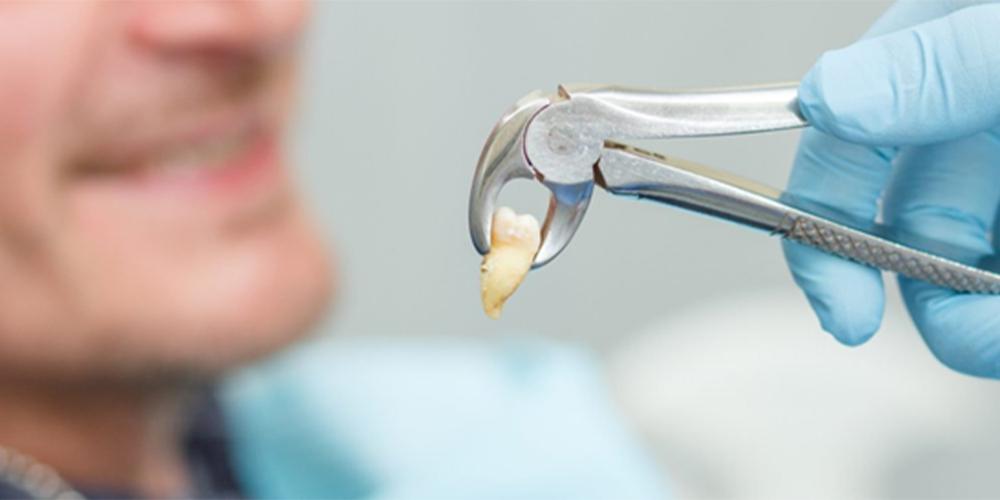 von einem Zahnarzt extrahierte Backenzähne
