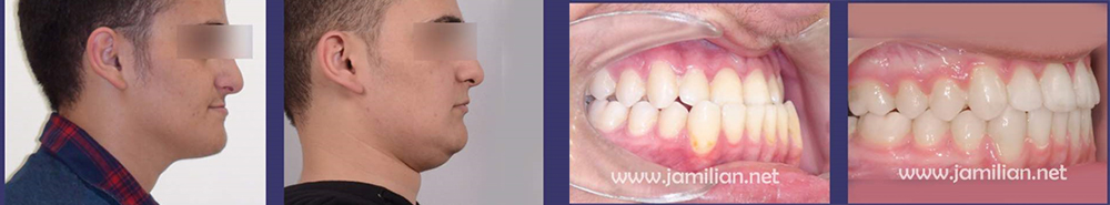 The effect of orthodontics and jaw correction on the face profile