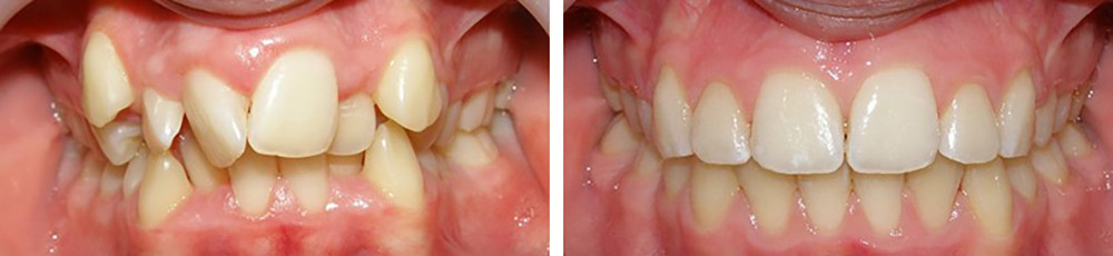 Bild vor und nach der kieferorthopädischen Behandlung von unregelmäßigen Zähnen