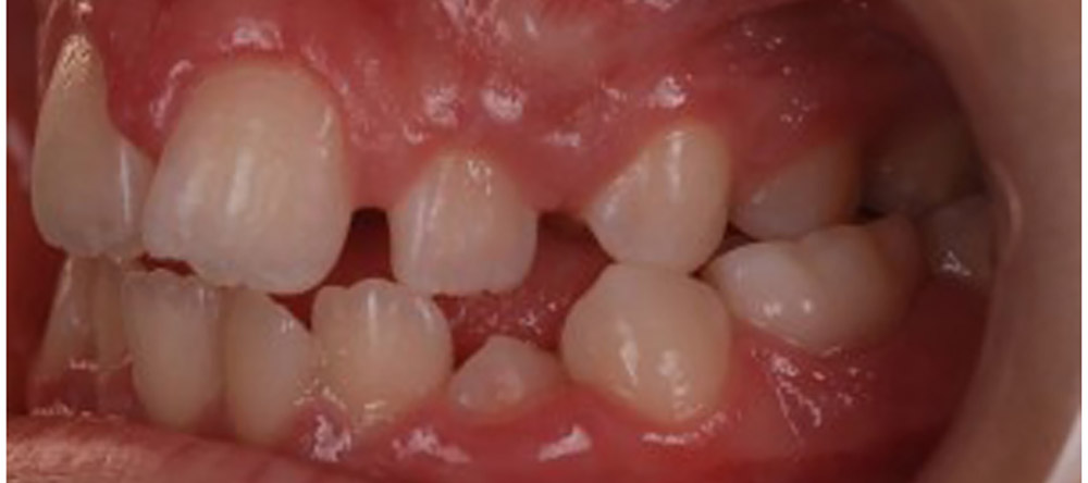 side view of Posterior crossbite