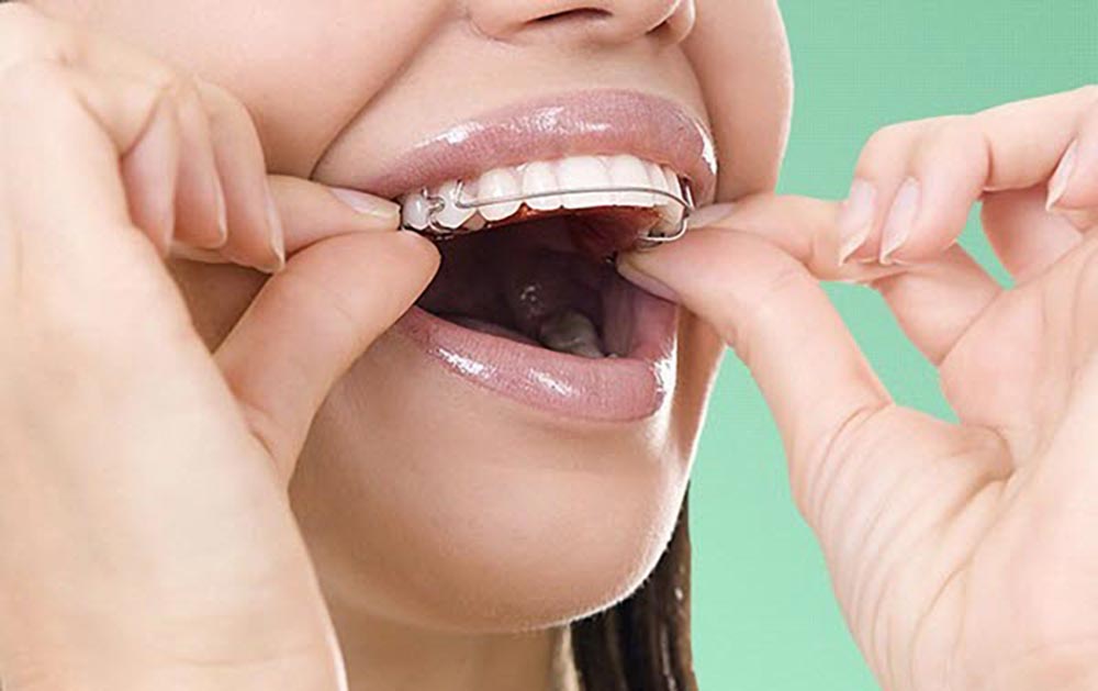 امرأة تخضع لتقويم الأسنان القابل للإزالة
