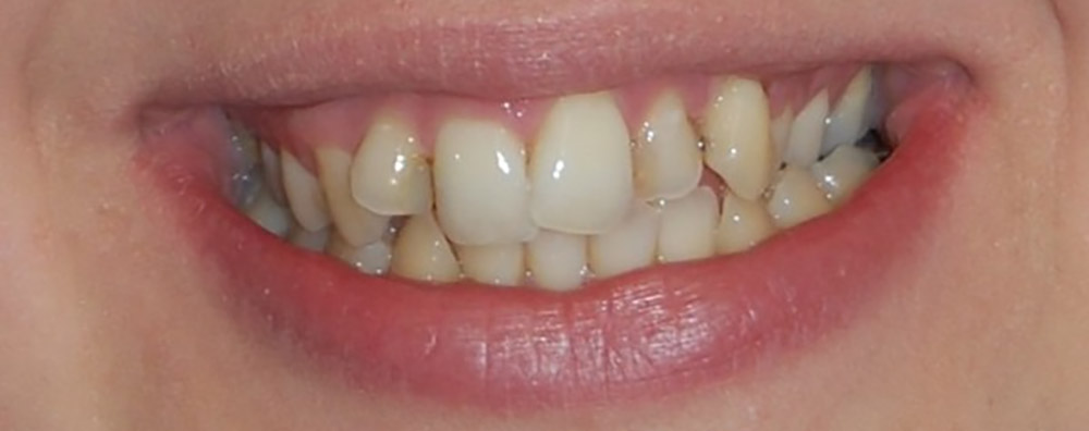 irregular tooth image leading to tooth decay and yellow teeth