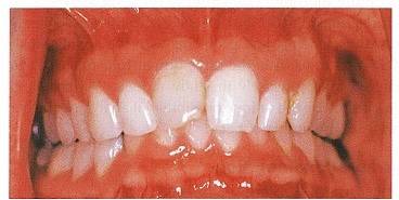 مورفولوژی غیرنرمال دندان های ثنایای سانترال