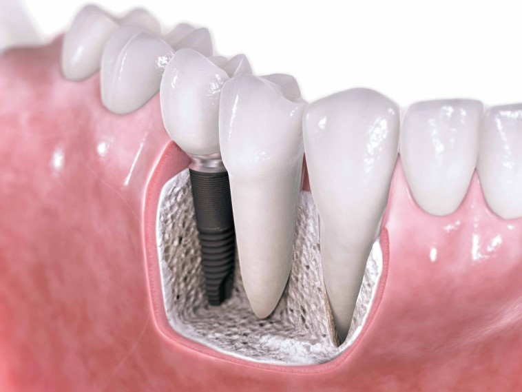 کاربردهای ایمپلنت های دندان