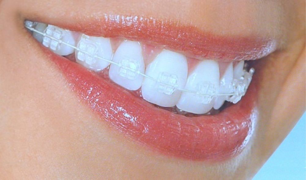 invisible orthodontic image with tooth-colored ceramic bracket which is one of the new orthodontic methods