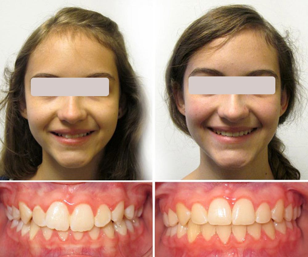 before and after overbite orthodontic treatment for little girl