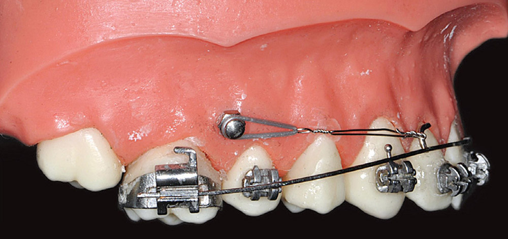 mini-screw is one of the modern orthodontic methods