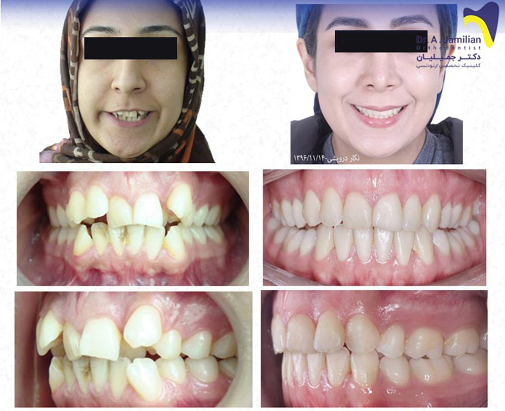 images before and after the face and teeth of a woman who has undergone orthodontic treatment of crowded teeth