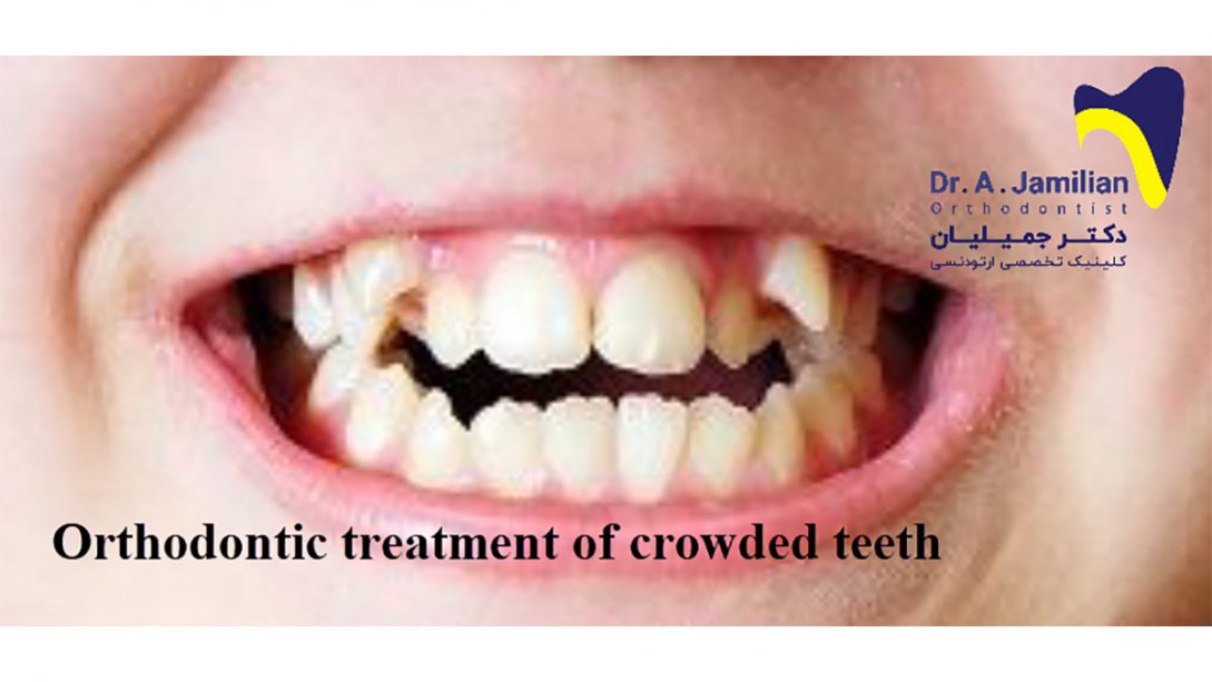 Orthodontic treatment of crowded teeth Dr Jamilian