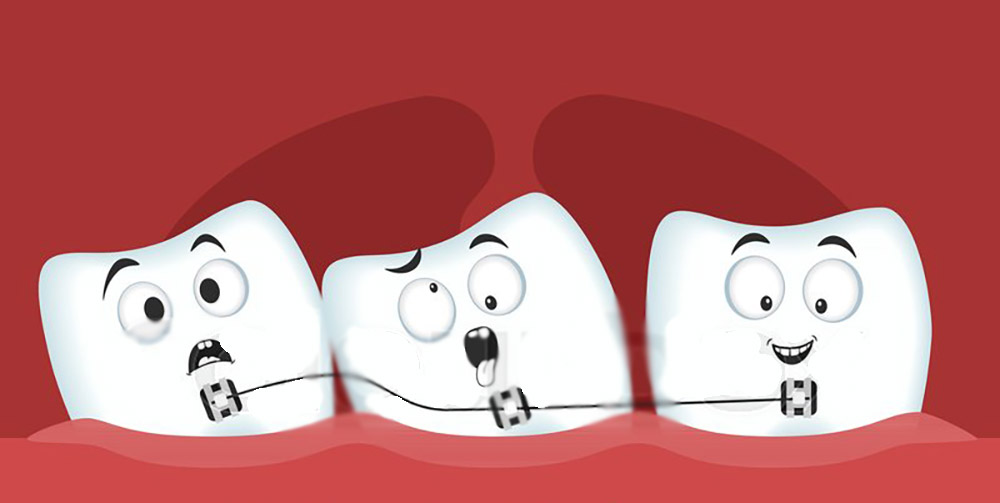 رسم تخطيطي للعلاج التقويمي للأسنان المزدحمة