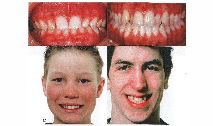 تمایل محوری تاج دندانهای خلفی