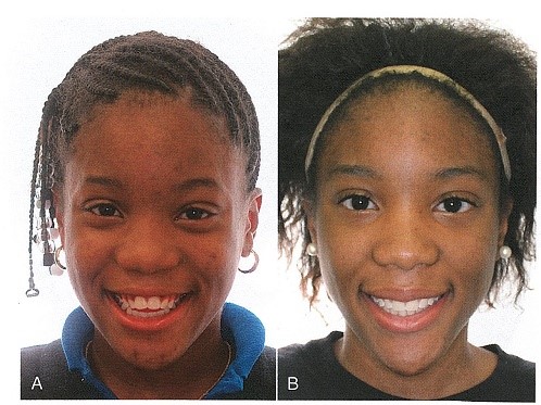 رابطه معکوس بین دندان های ثنایای بالا و لب های پایین