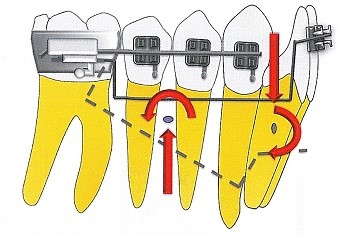 طراحی بیومکانیک اینروژن دندان