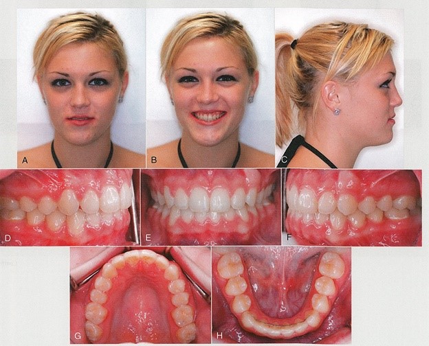 دندان کانین بعد از درمان ارتودنسی