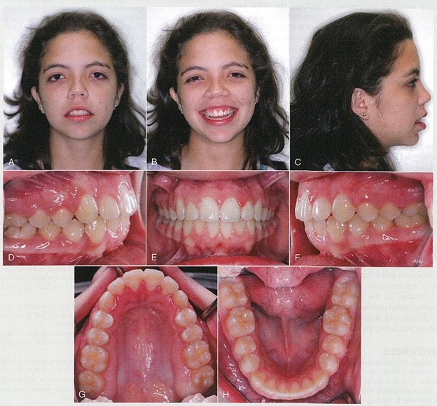 دندان های کانین بعد از درمان