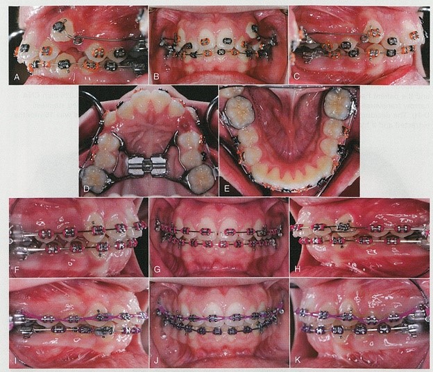 دندان های کانین طی درمان