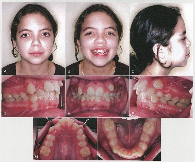 پروفایل دندان کانین قبل از درمان